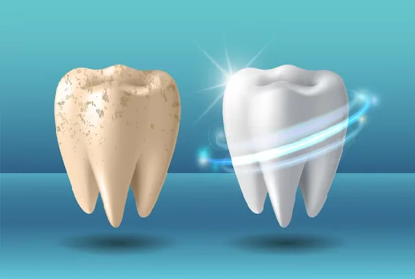 Teeth Cleaning