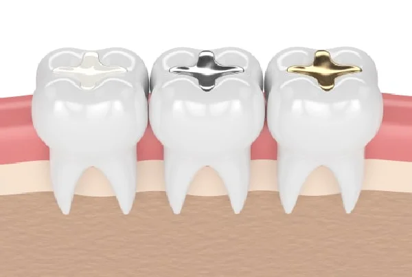 Dental Fillings